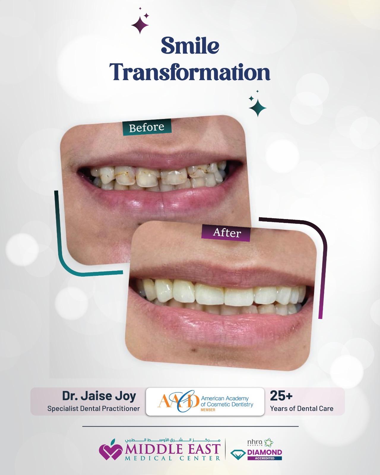 Complete smile transformation